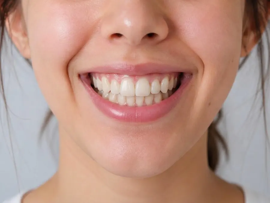 Caso 1 de alinhamento dental — depois do tratamento com Invisalign